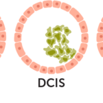 A microscope image of ductal carcinoma in situ